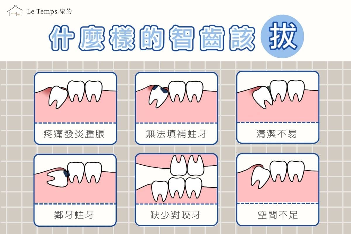 什麼樣的智齒該拔