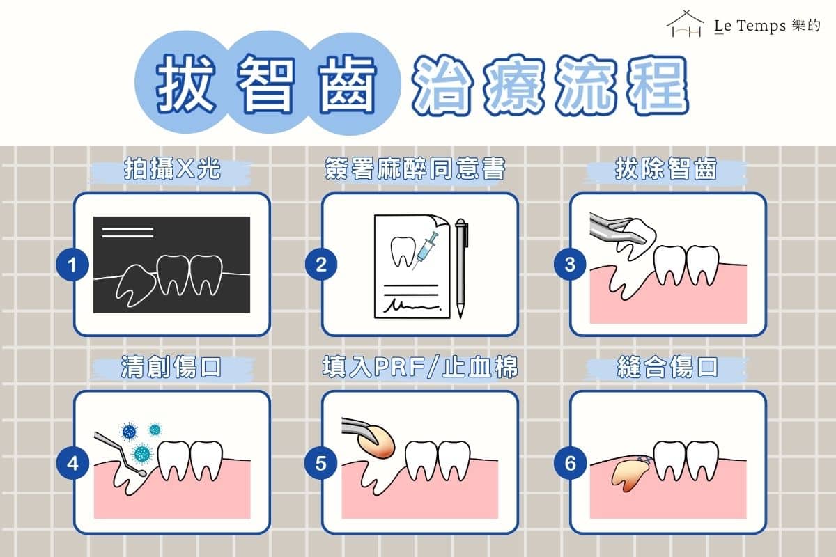 拔智齒流程