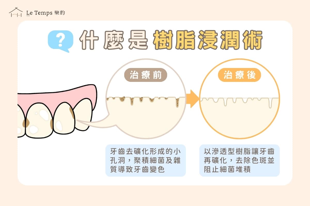 樹脂浸潤術是什麼