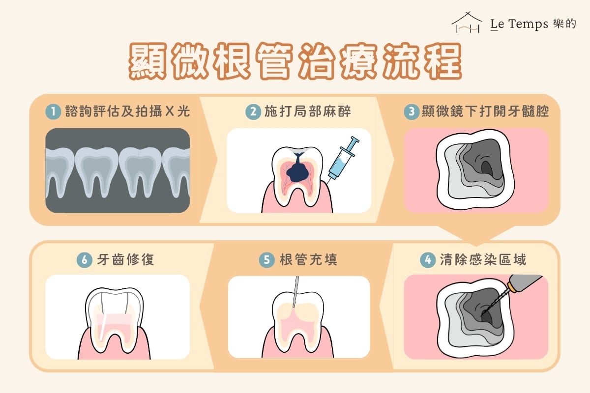 顯微根管流程