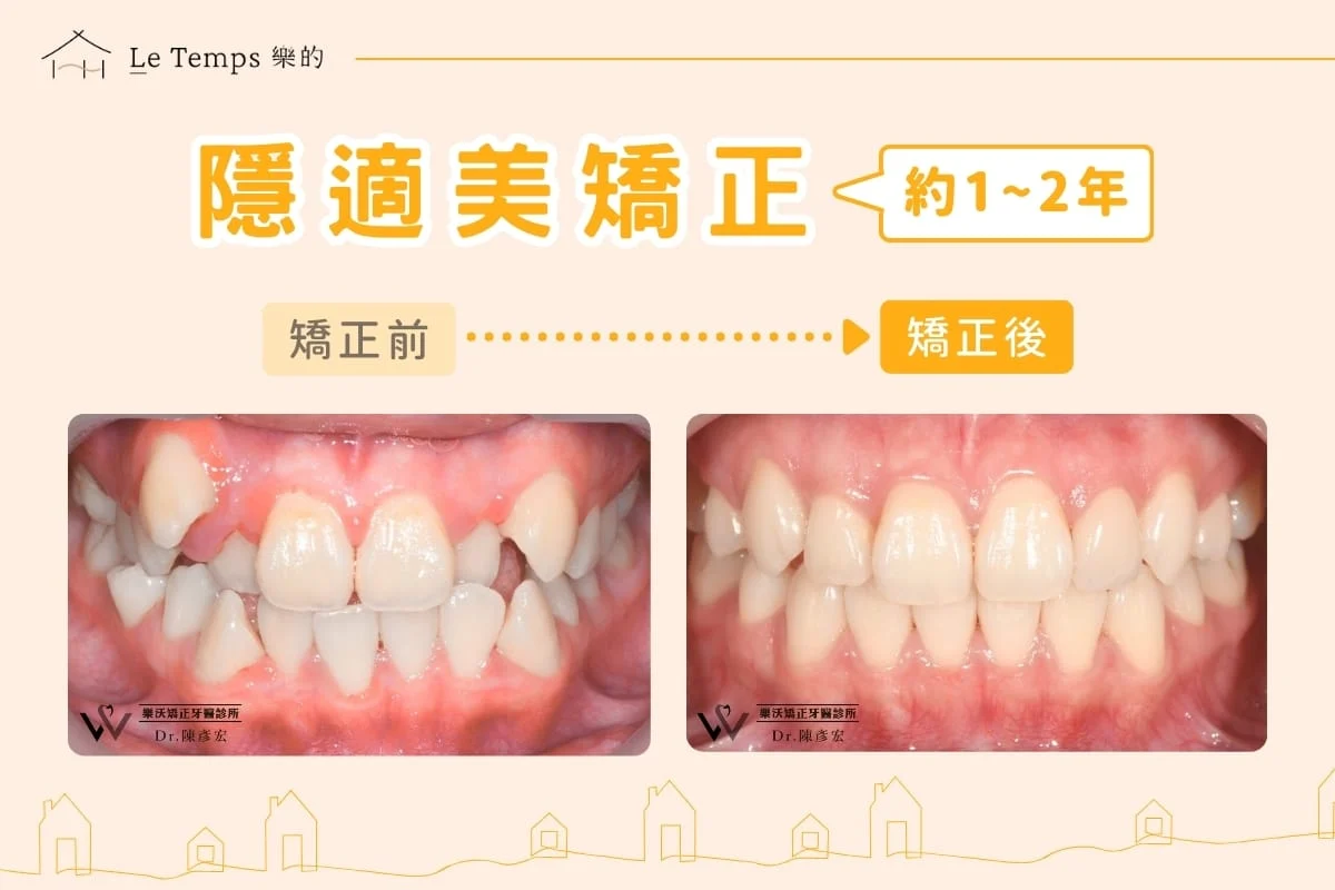 隱適美矯正案例