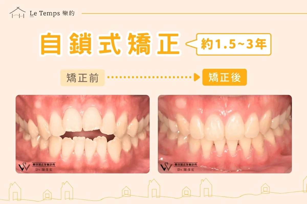 自鎖式矯正案例