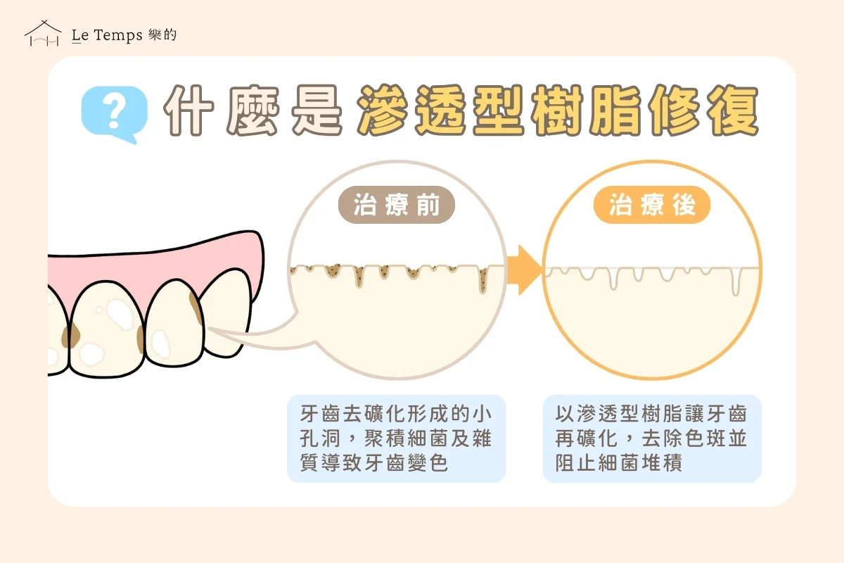 滲透型樹脂修復是什麼？