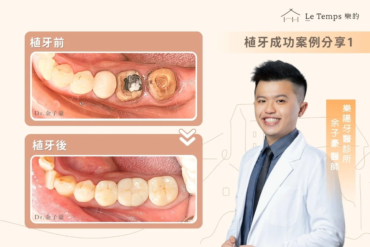植牙案例