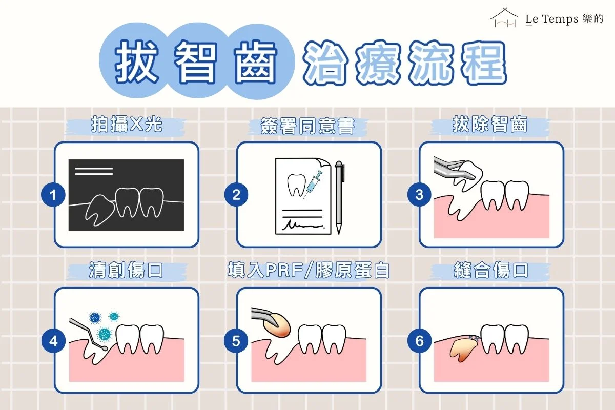 拔智齒治療流程