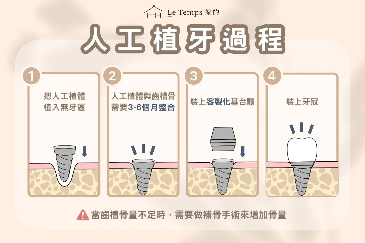 人工植牙流程