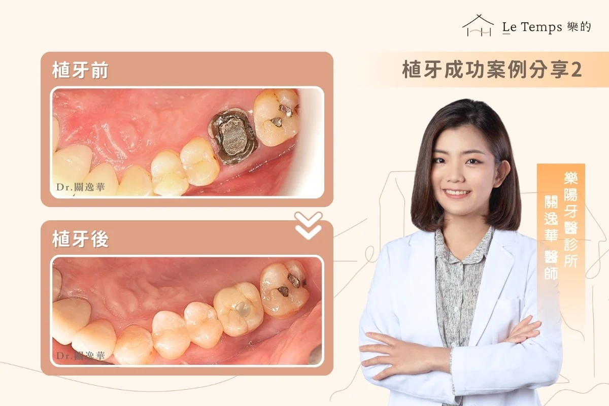 植牙案例