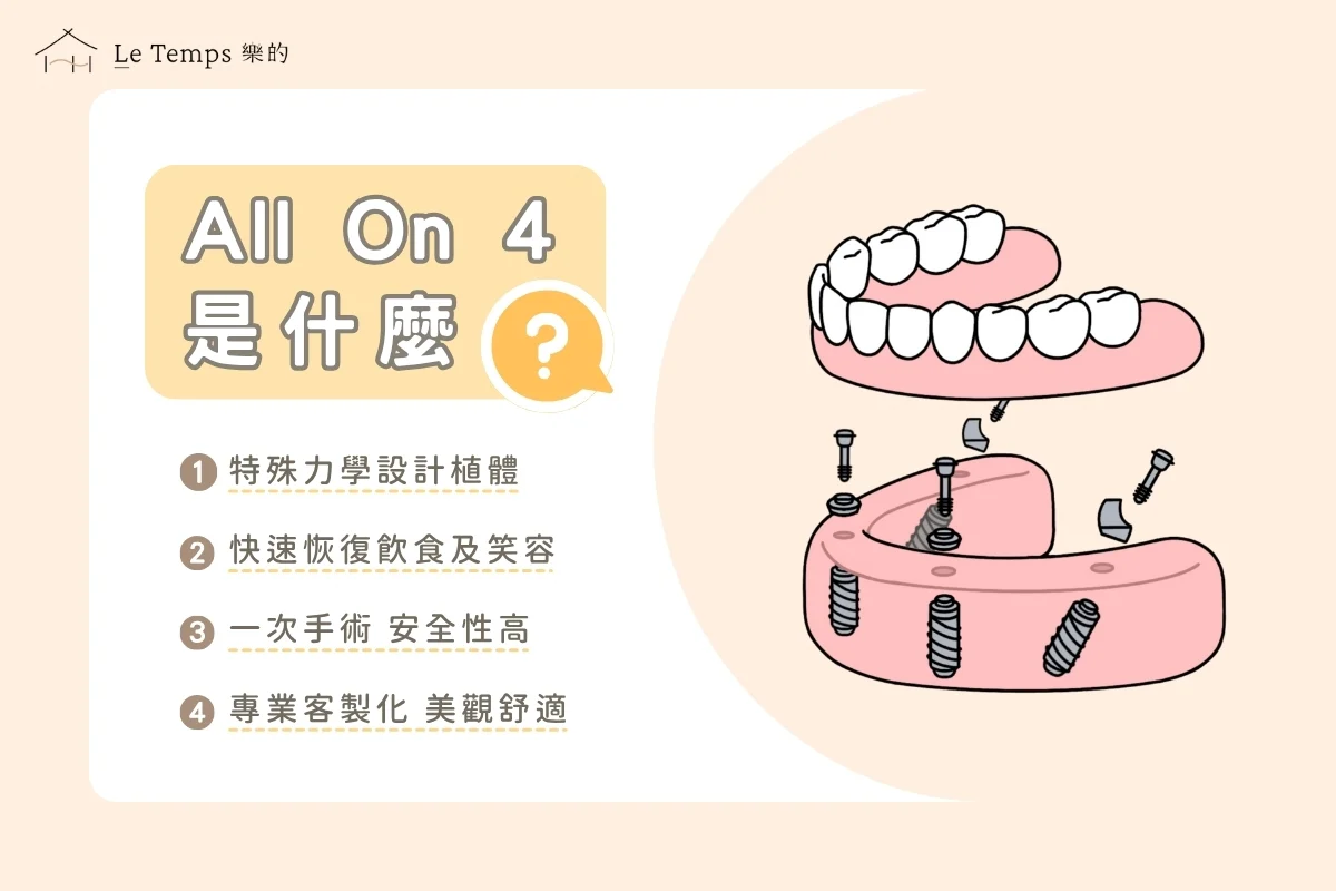 全口重建all On 4是什麼？