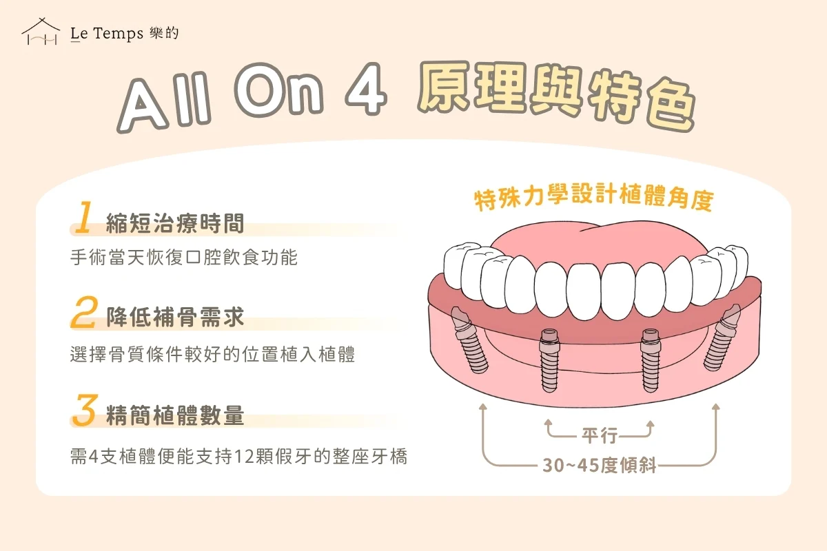 全口重建all On 4 原理與特色
