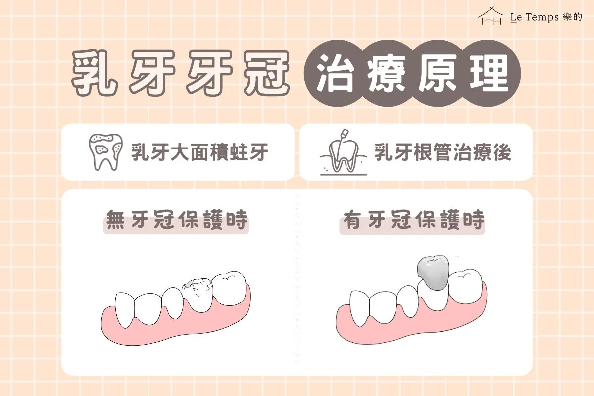 乳牙牙冠治療原理