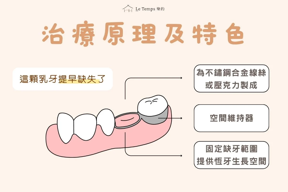 空間維持器治療原理及特色