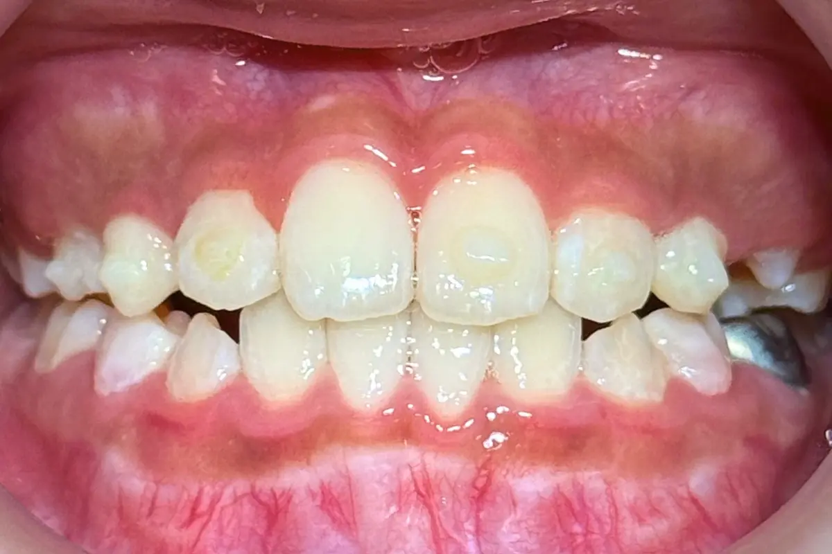 兒童隱適美＿術後