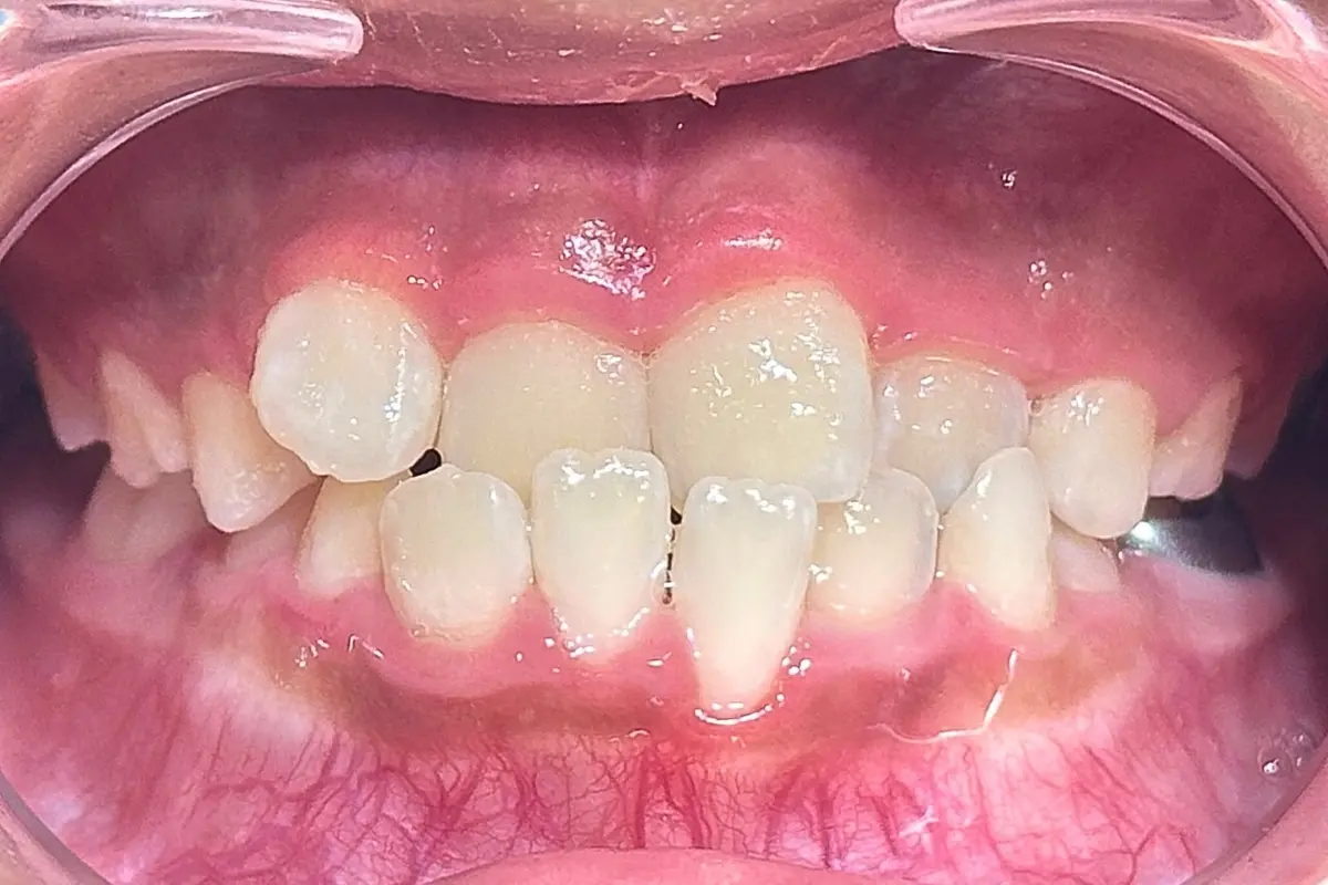 兒童隱適美＿術前