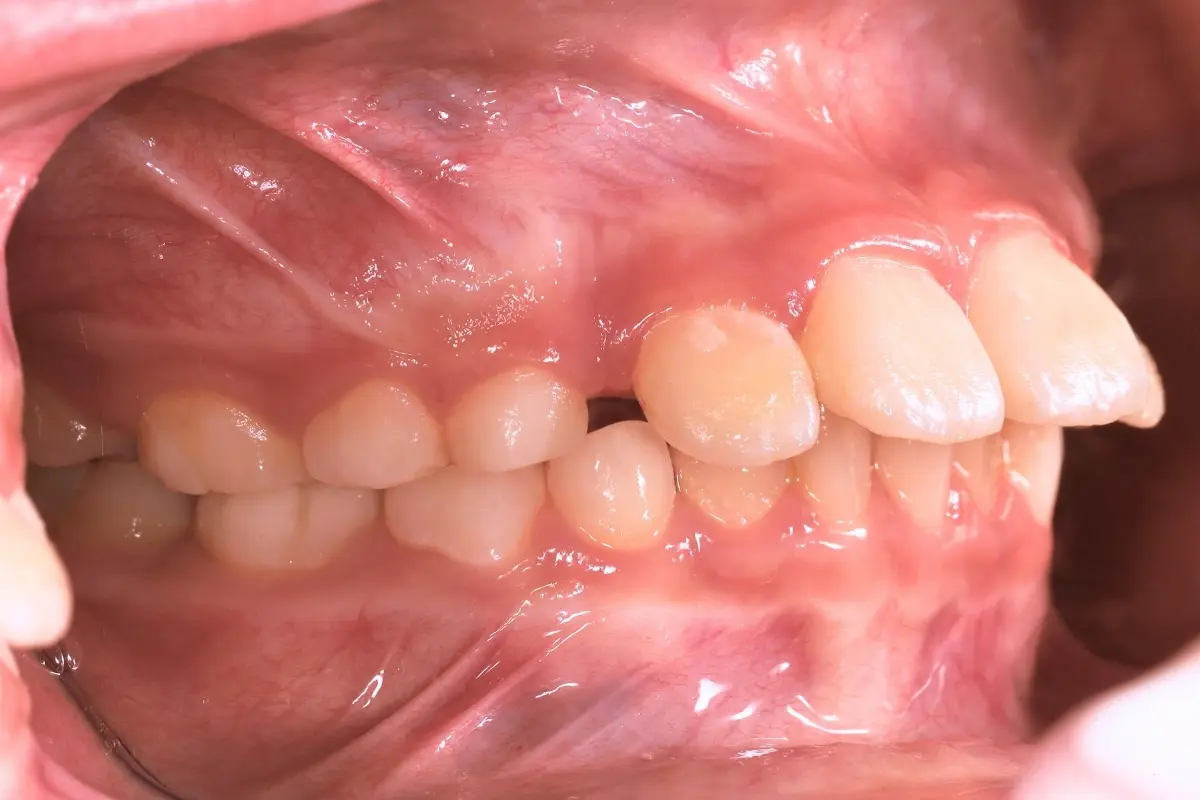 兒童隱適美＿術前