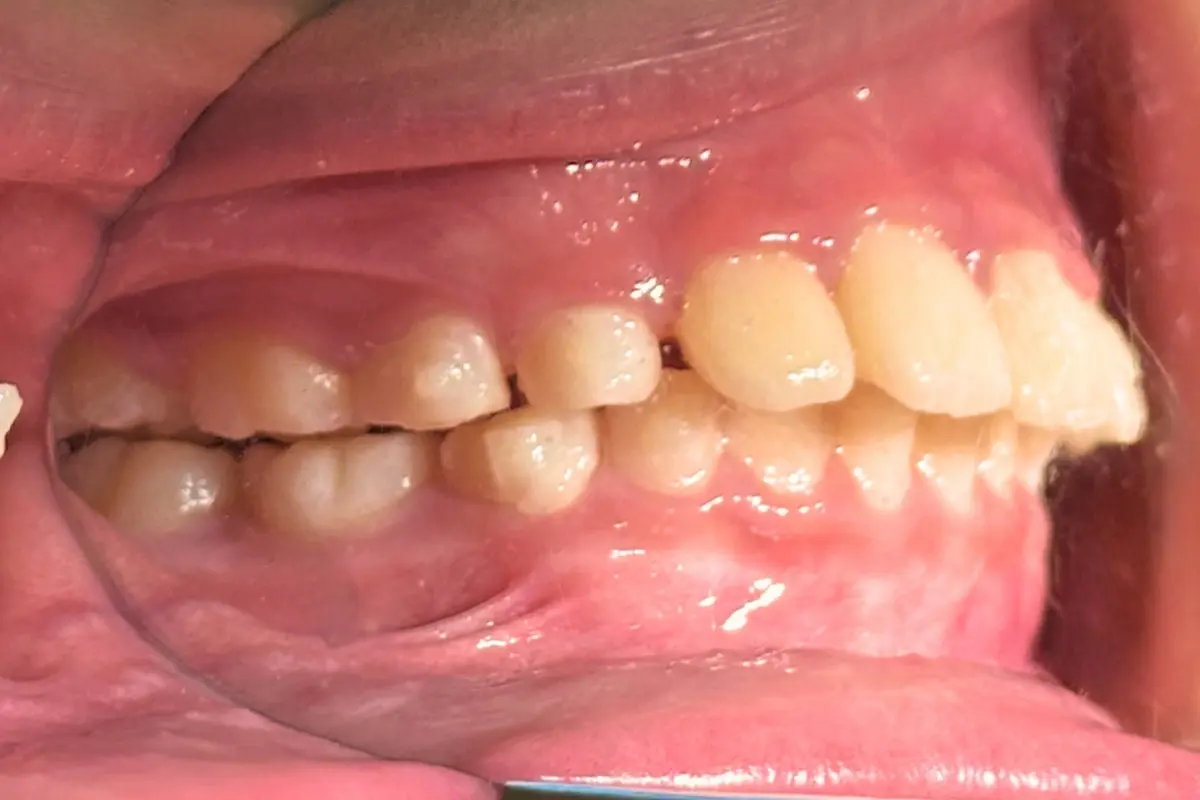 兒童隱適美＿術後