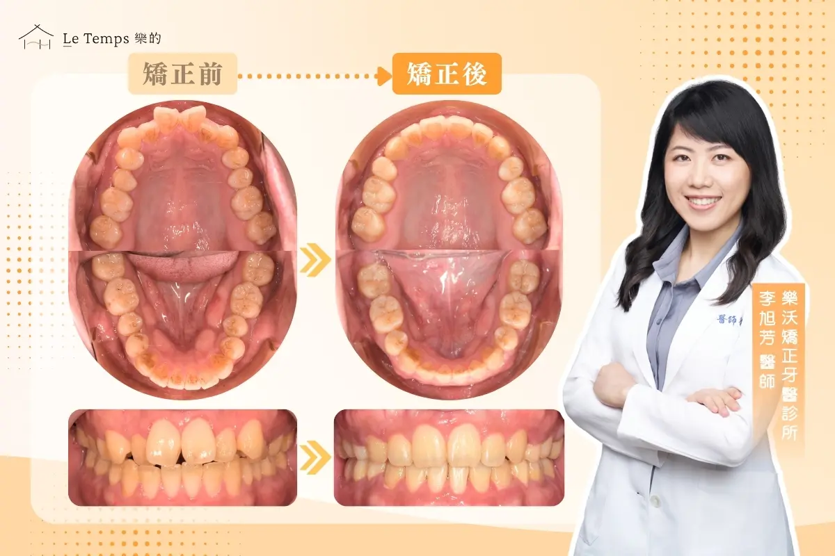 0624自鎖式矯正案例分享2