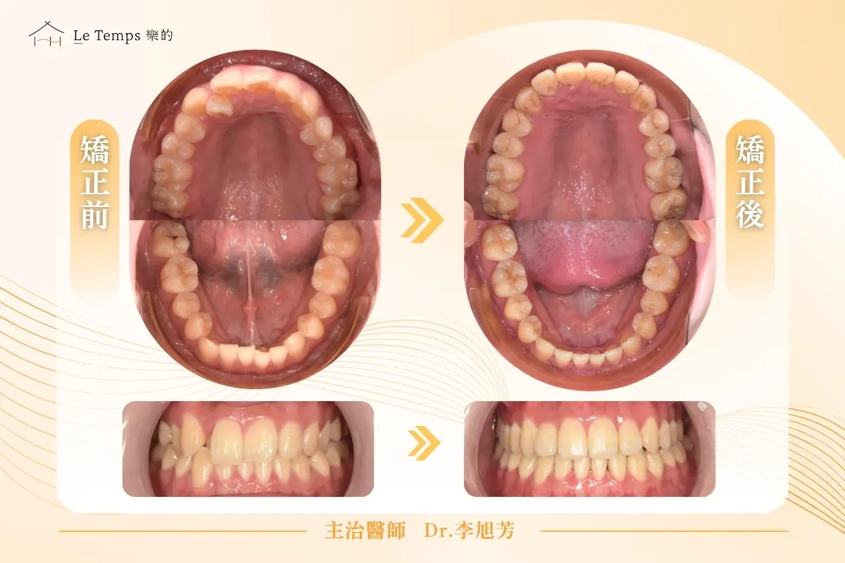 0820自鎖式矯正案例分享2