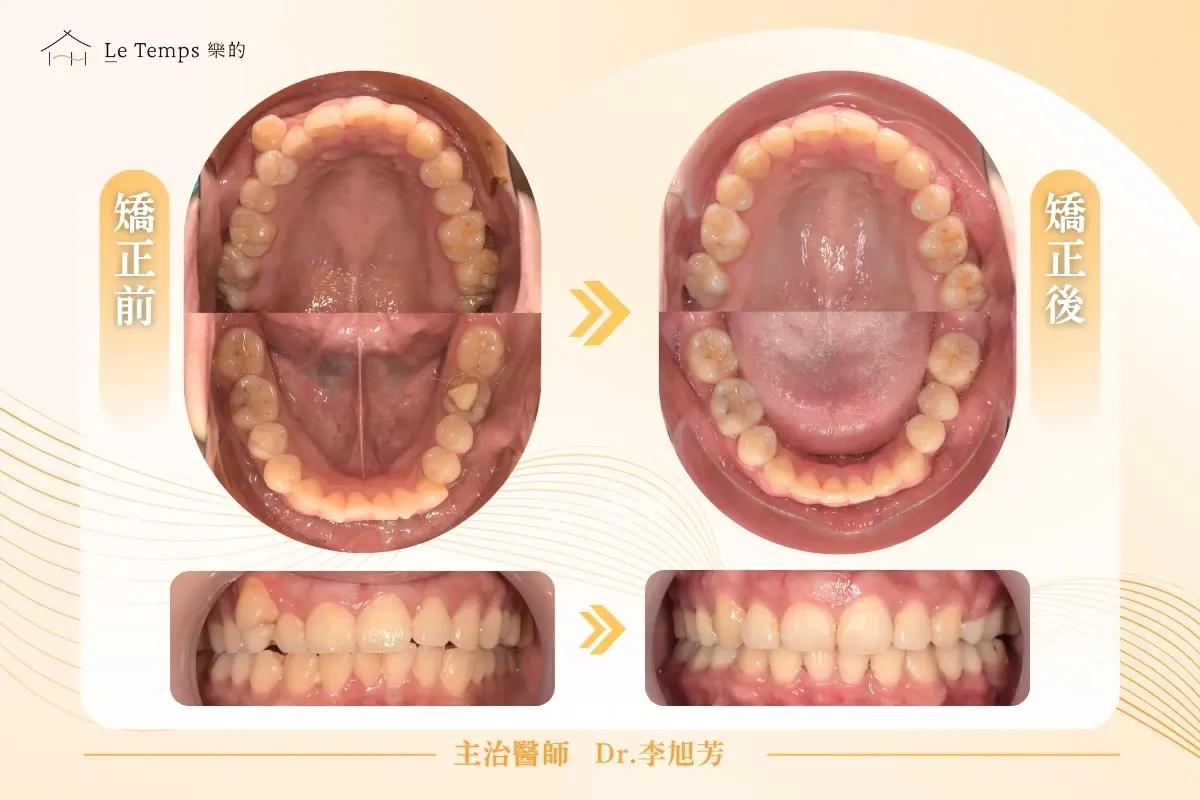 0804自鎖式矯正案例分享2