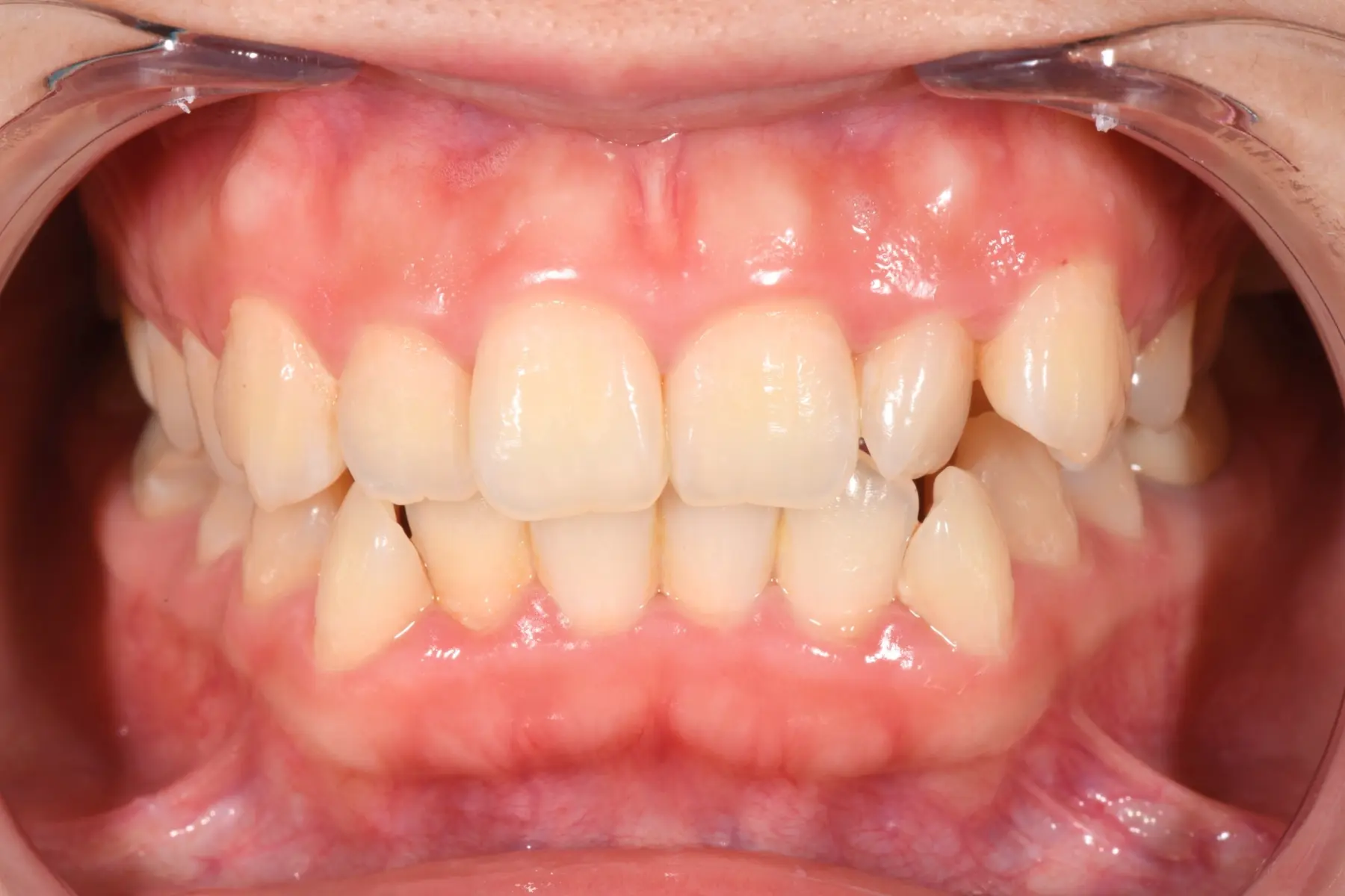 自鎖式矯正術前