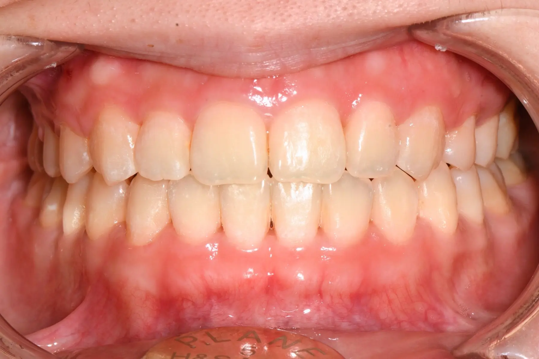 自鎖式矯正術後