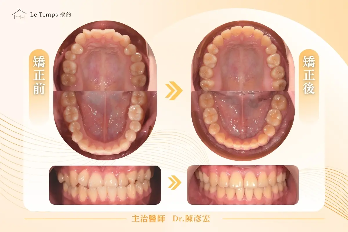 0811自鎖式矯正2