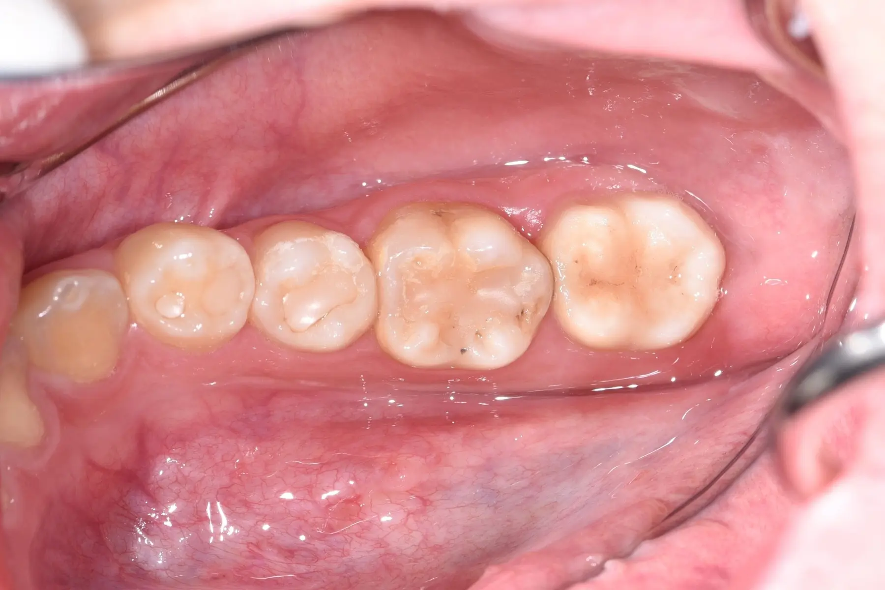 自體牙移植術後