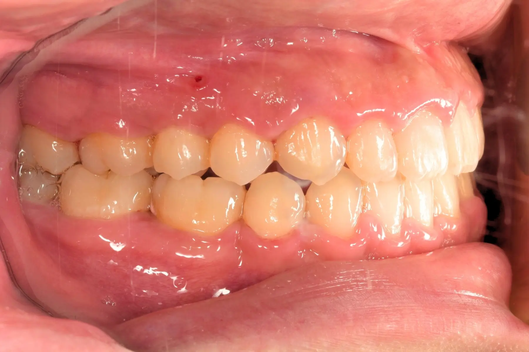 自鎖式矯正術後