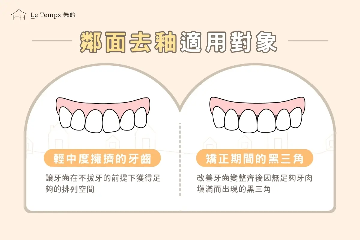 治療項目 鄰面去釉4