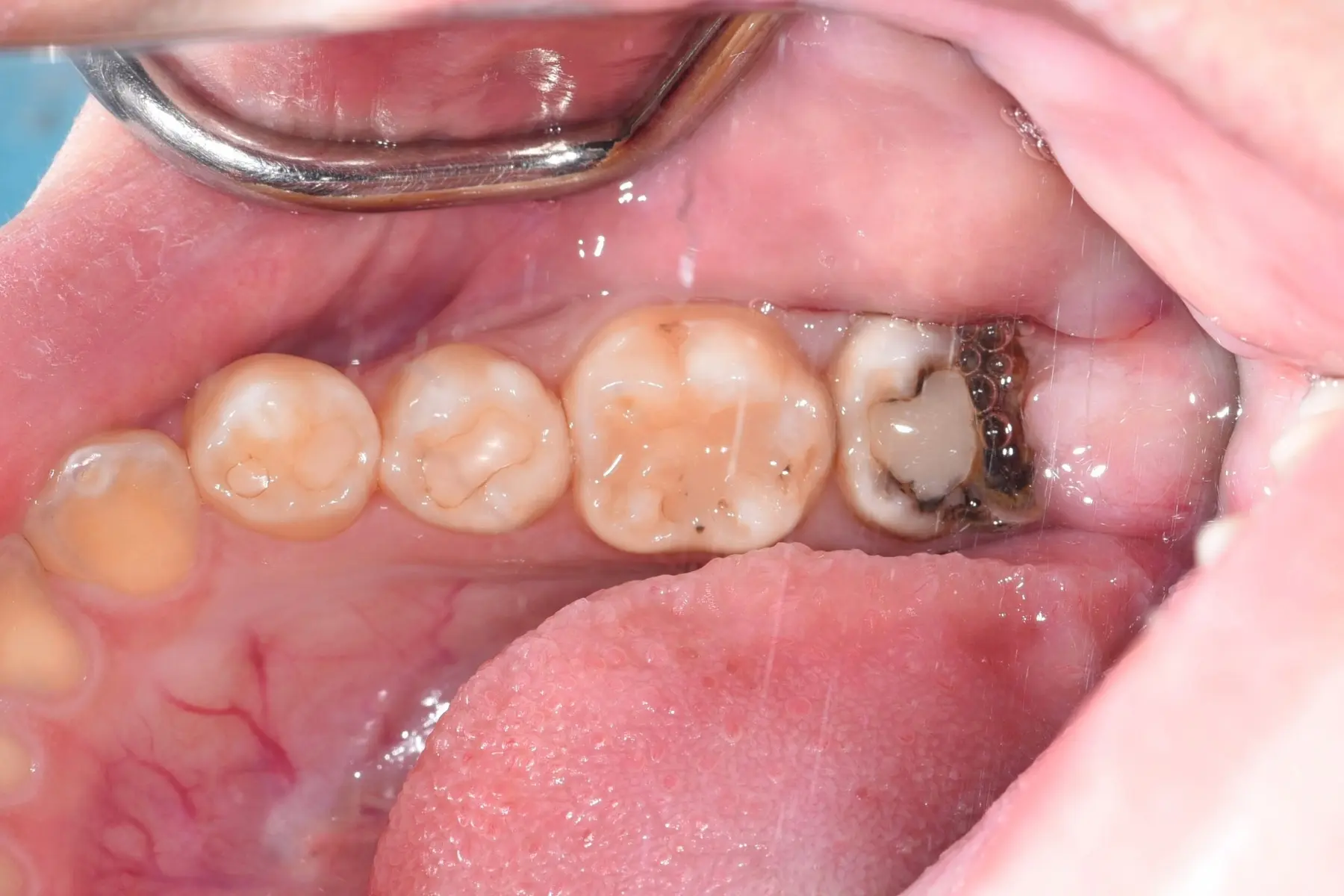 自體牙移植術前