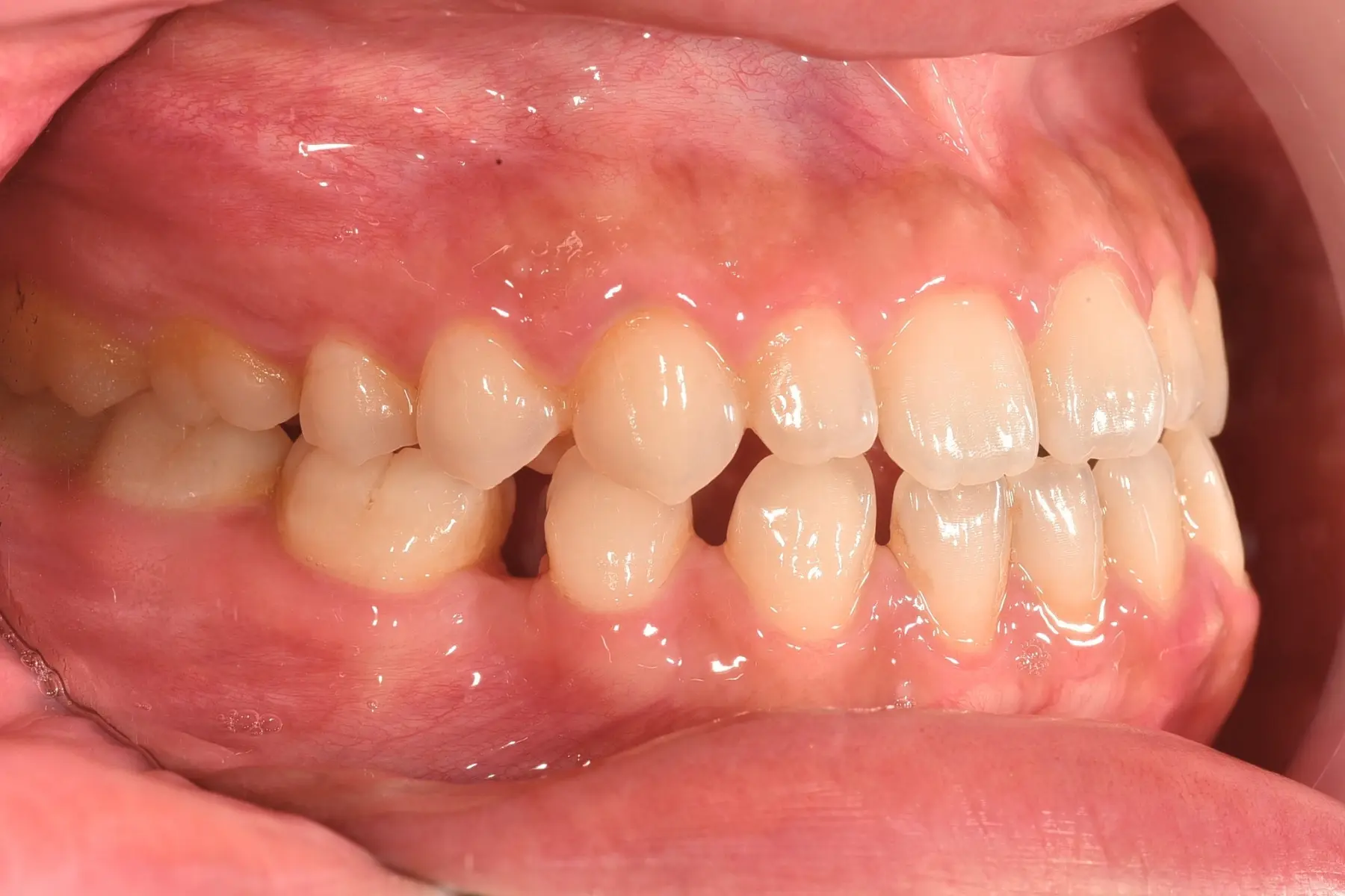 自鎖式矯正術前