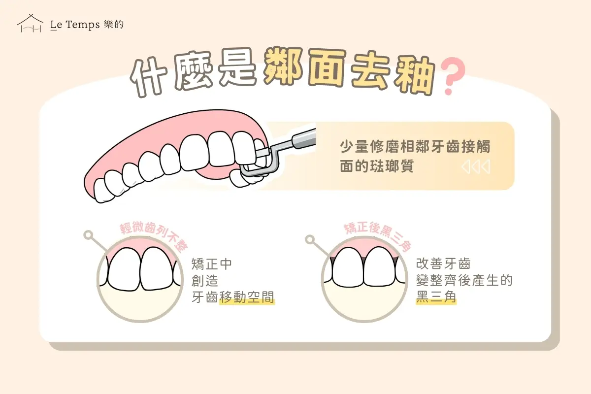 治療項目 鄰面去釉1