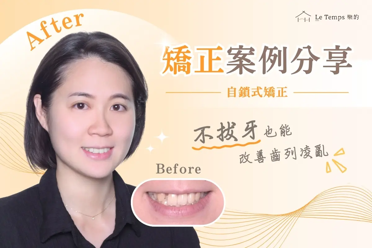 0820自鎖式矯正案例分享1