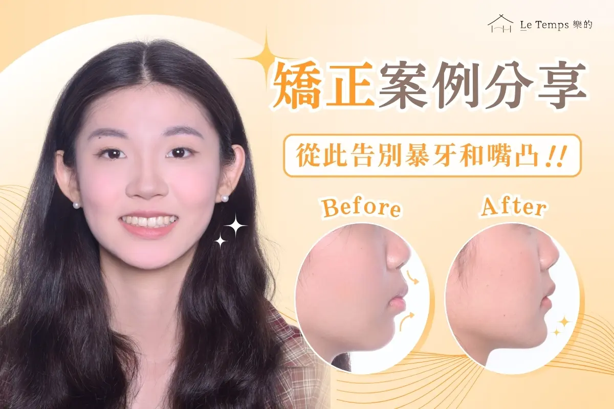 0904自鎖式矯正案例分享1