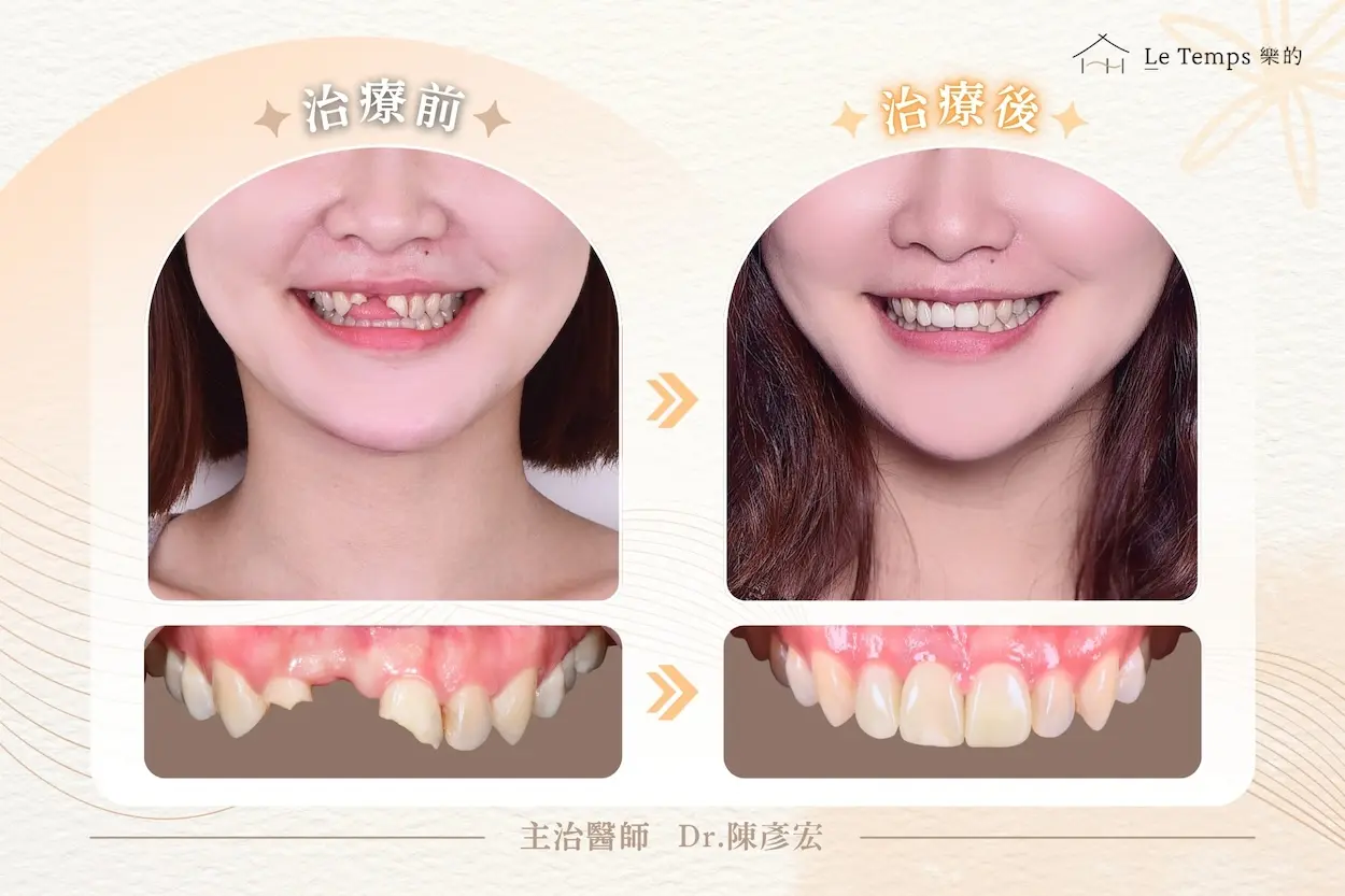 0910人工植牙案例分享2