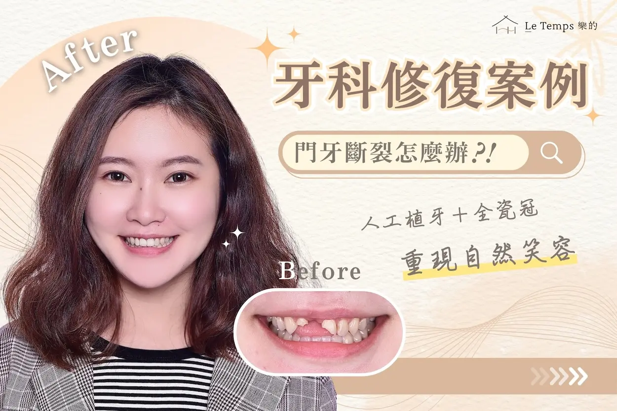 0910人工植牙案例分享1