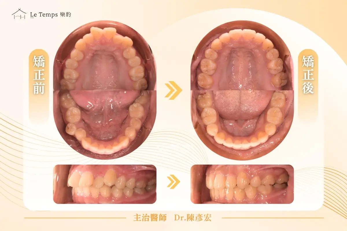 0904自鎖式矯正案例分享2