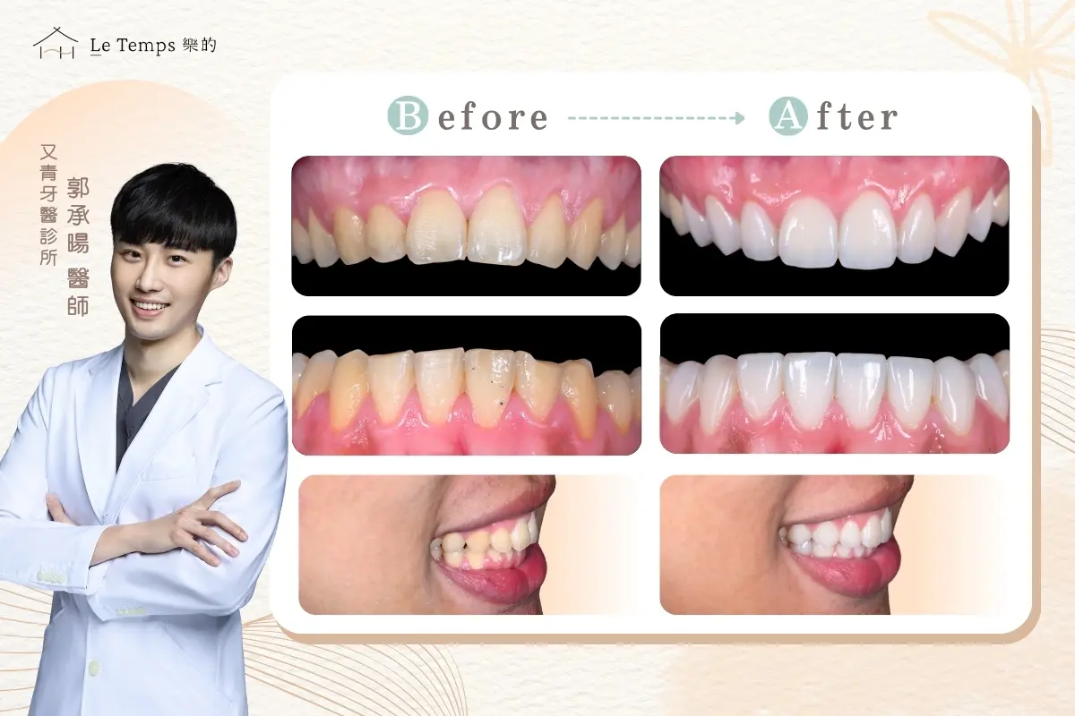 1014陶瓷貼片案例分享2