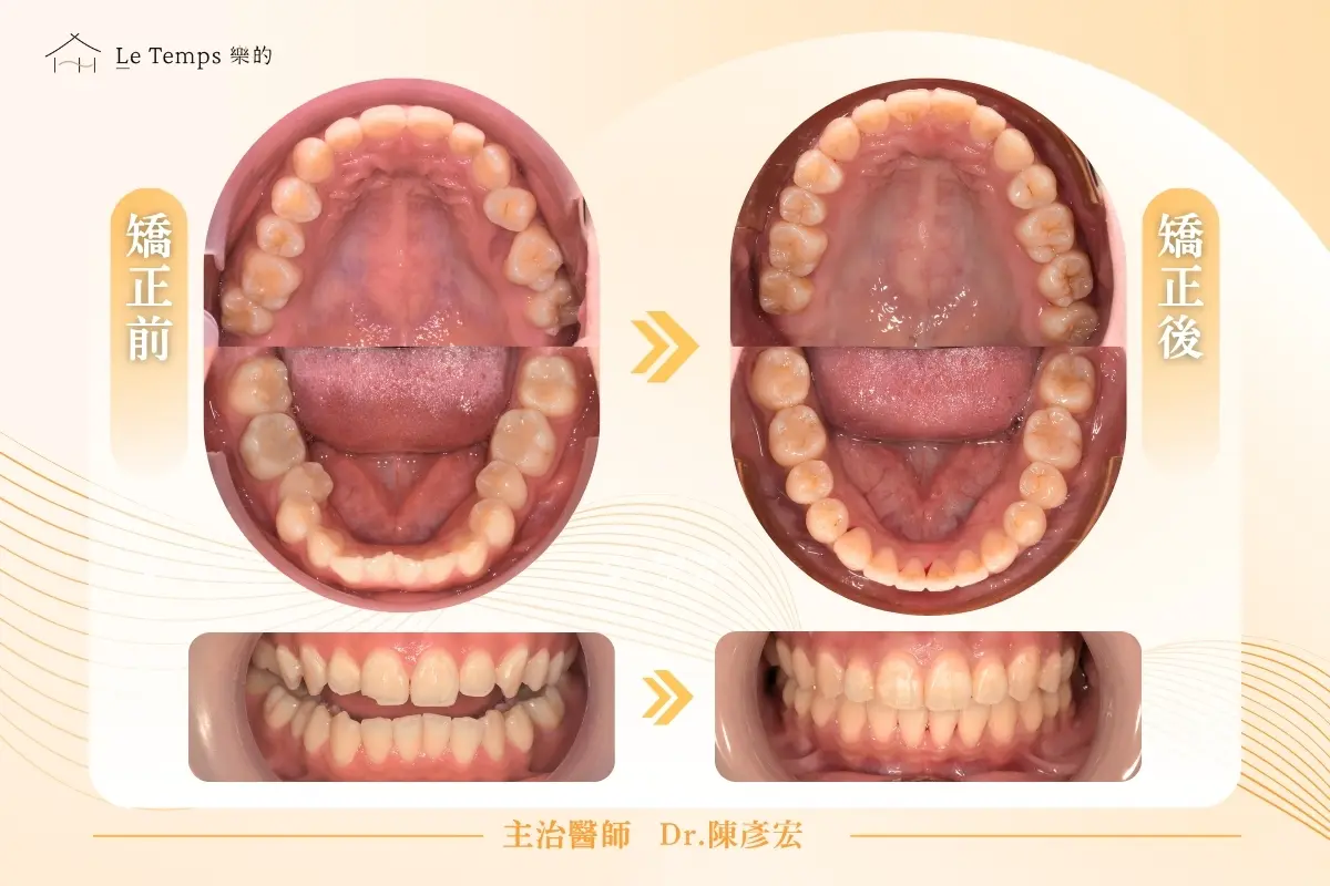 1020自鎖式矯正案例2