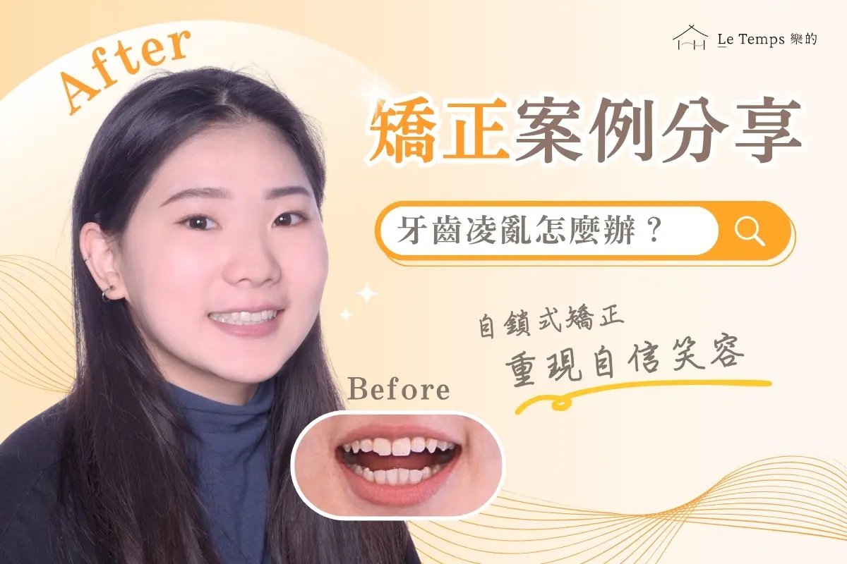 1020自鎖式矯正案例1