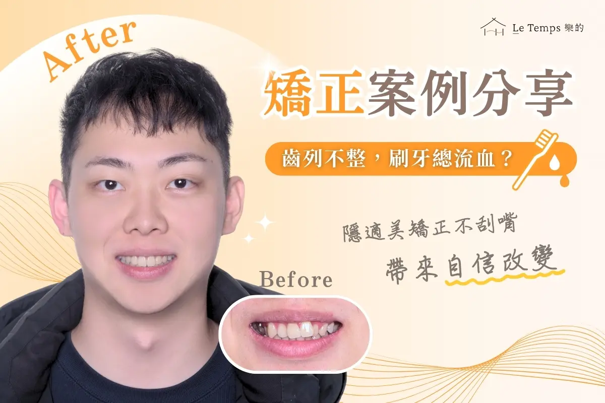 1030程弘希隱適美矯正案例分享1