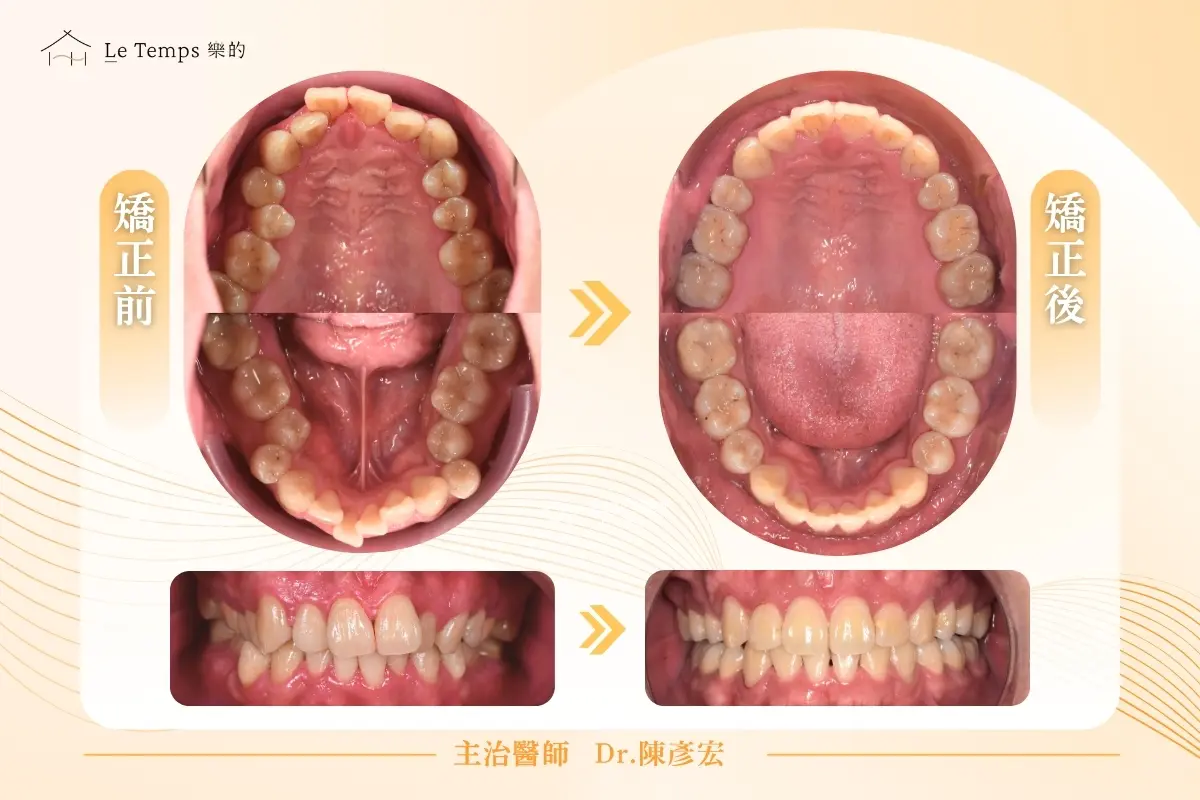 1030程弘希隱適美矯正案例分享2