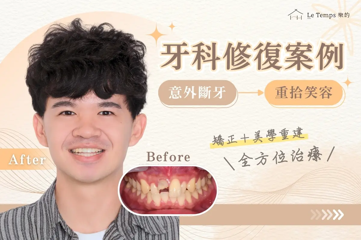 1124仿生全瓷牙案例分享1