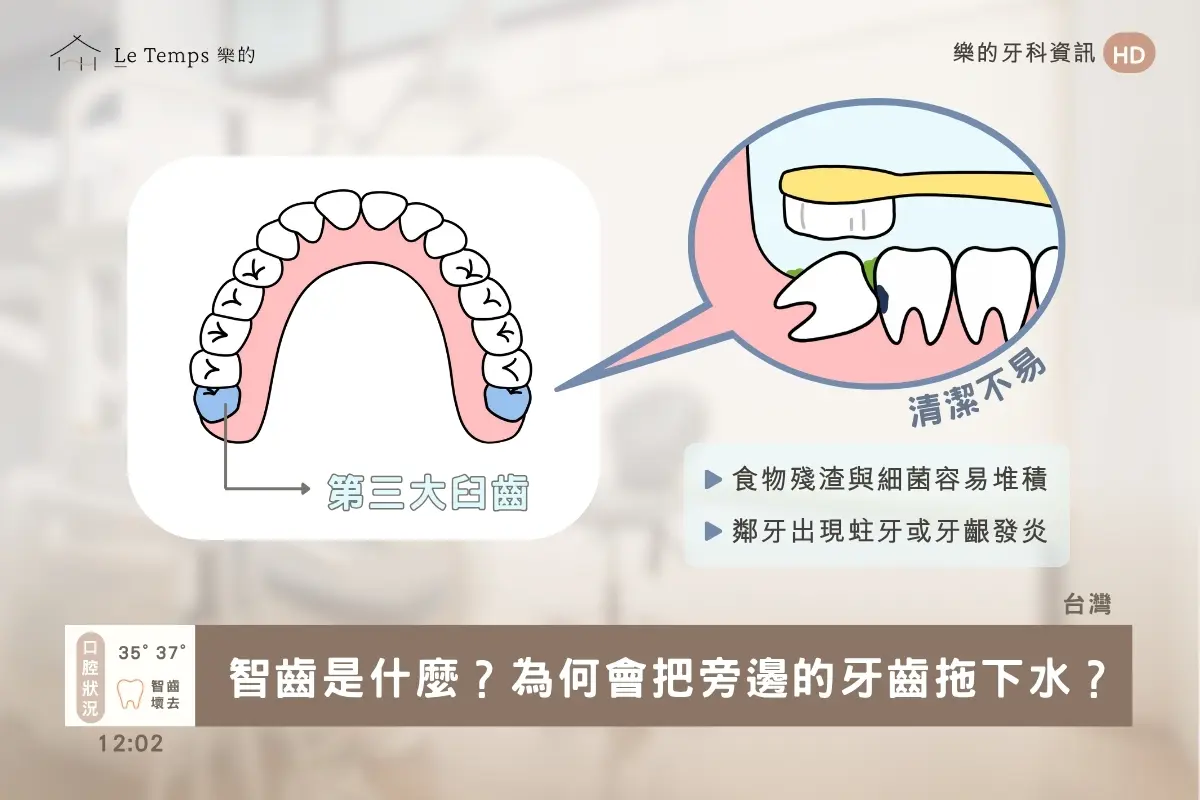 阻生智齒一定要拔嗎3