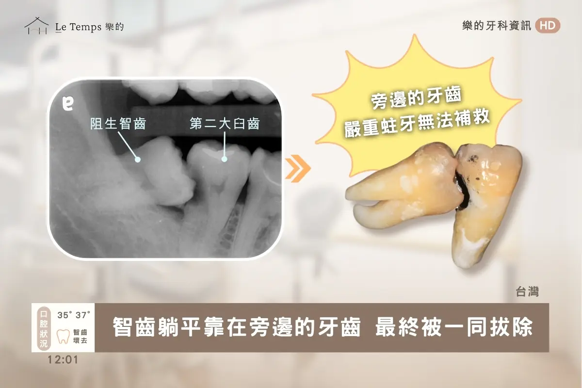 阻生智齒一定要拔嗎2