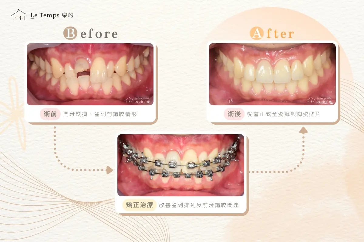 1124仿生全瓷牙案例分享2