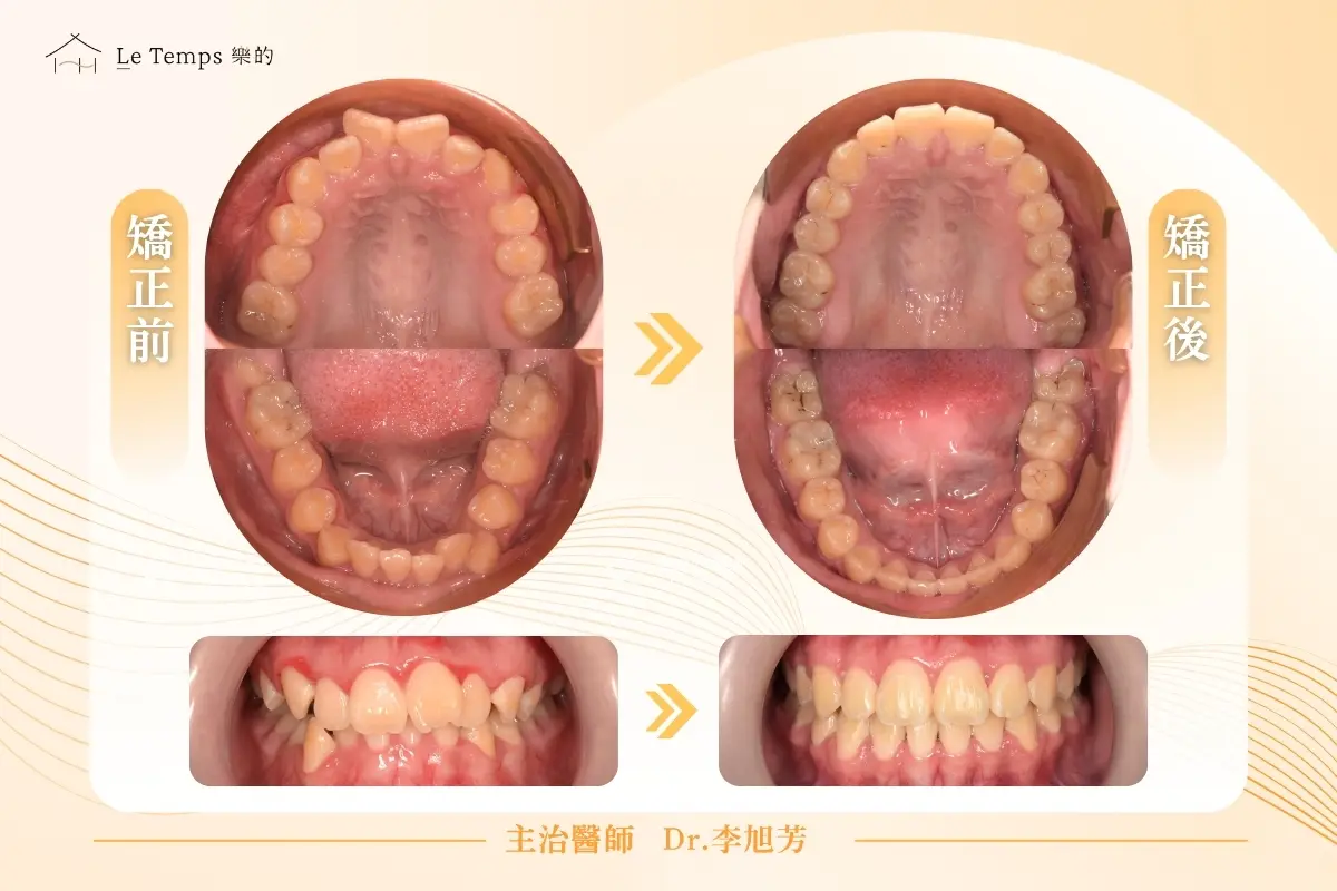 1104自鎖式矯正案例分享2