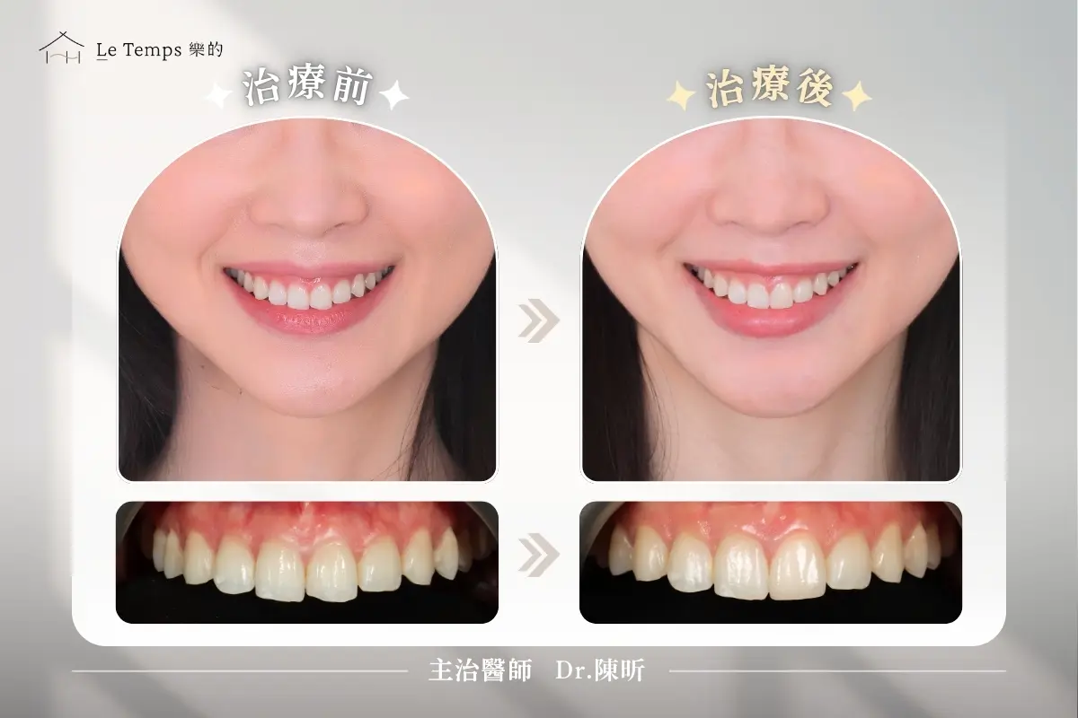 1215陶瓷貼片案例分享3