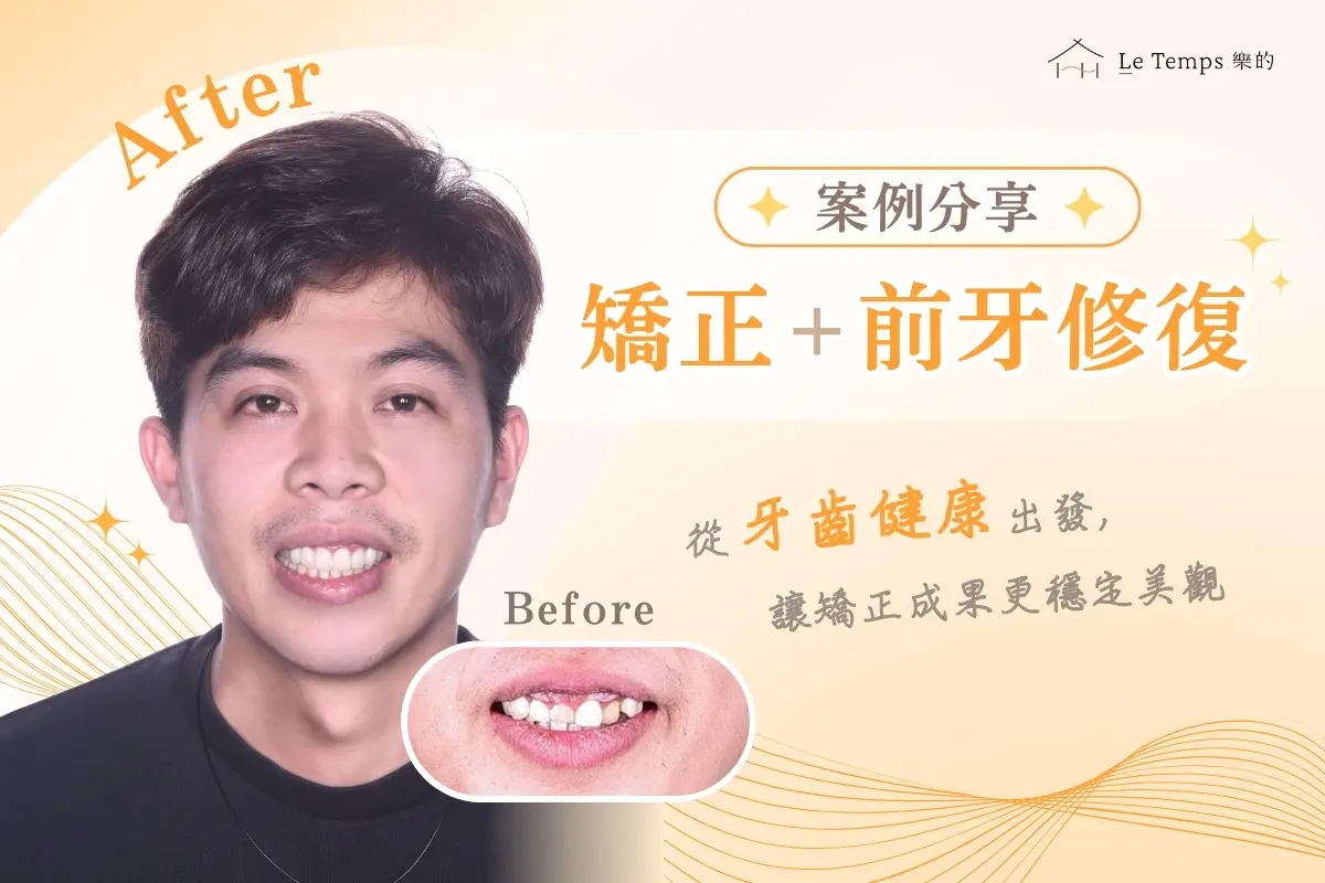 1208自鎖式矯正陶瓷貼片案例分享1