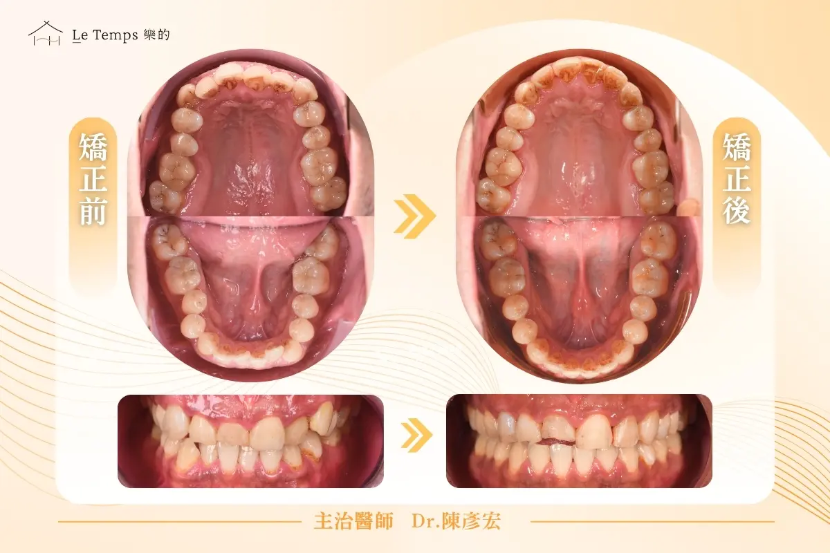1208自鎖式矯正陶瓷貼片案例分享3