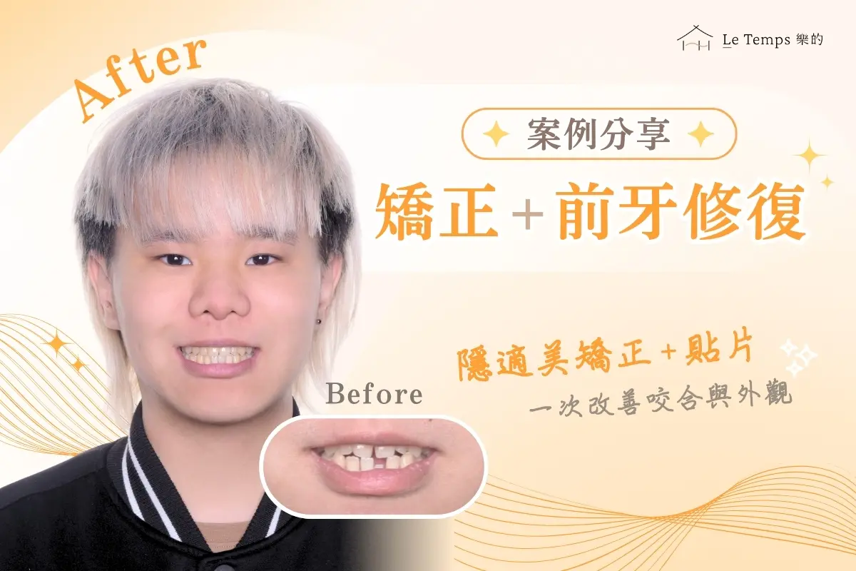 1215隱適美矯正陶瓷貼片案例分享1